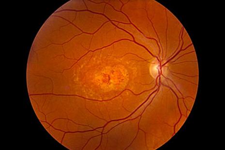 Inherited Retinal Dystrophies. Photo Credit: Elias Traboulsi, MD, M.Ed