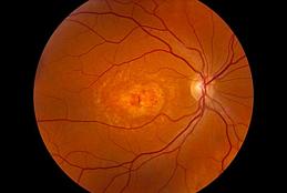 Inherited Retinal Dystrophies. Photo Credit: Elias Traboulsi, MD, M.Ed